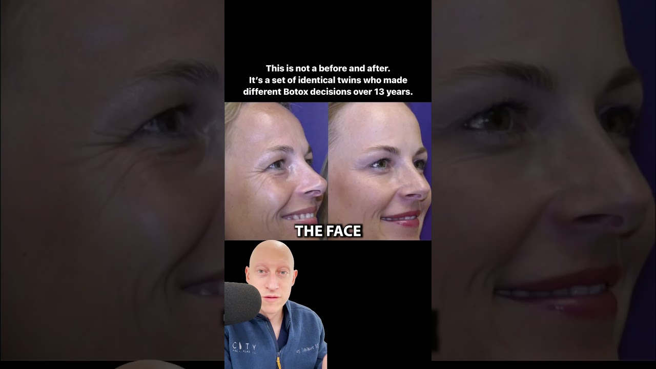 Botox vs NO Botox