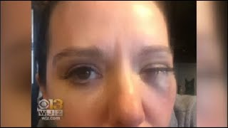 Victim Speaks Out After Being Robbed, Assaulted In Fells Point