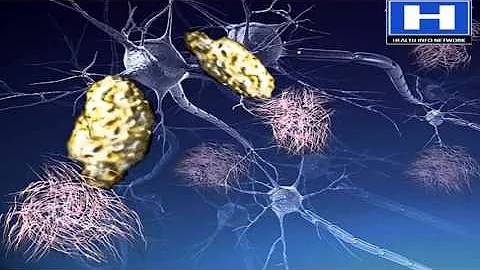 Alzheimer's disease Pathophysiology, Symptoms, Causes and Treatment | 3D animation