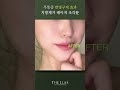 울퉁불퉁한 얼굴 군살 지방제거 레이저로 통증 없이 반영구적으로 가능합니다 #shorts