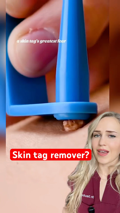 Doctor reacts to “miracle” mole remover