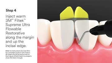 Triangles noirs Bioclear® 3M(MC)