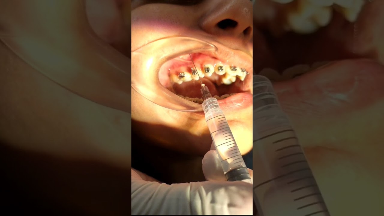 Removal of Premolar in orthodontic treatment/Premolar extraction in