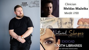 RPD removable partial denture "Flipper" on basic Exocad without PartialCAD module