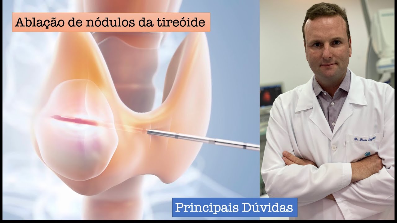 Como se opera un nodulo tiroideo