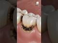 Gumline Meltdown 😨 | Cervical Decay Removal &amp; Tooth Restoration #ai #satisfying #shorts #trending