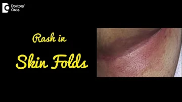 INTERTRIGO | Rash in Skin Folds | Causes, Symptoms, and Treatment - Dr.Nischal K C | Doctors' Circle