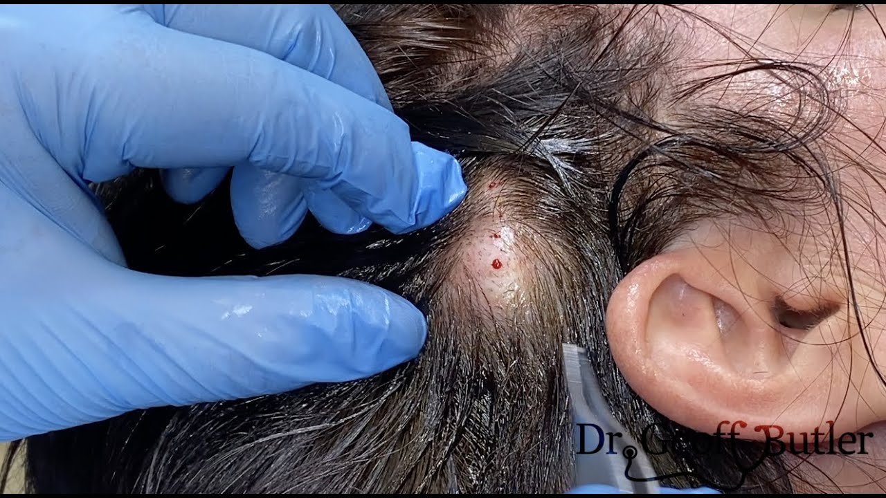 Cyst