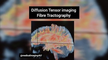 Diffusion Tensor imaging of the brain|DTI imaging|MRI Brain