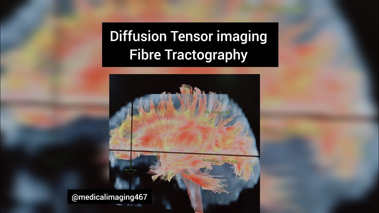 Diffusion Tensor imaging of the brain|DTI imaging|MRI Brain - YouTube