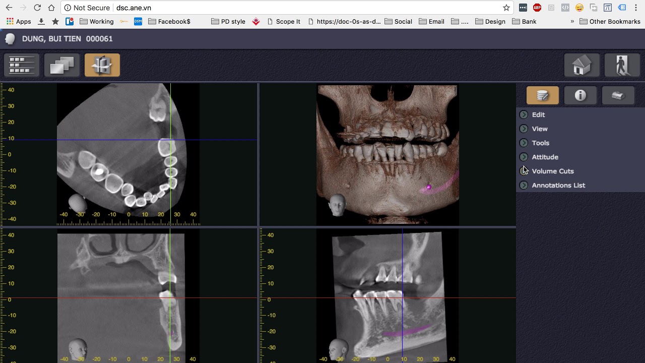 Morita 3D CT conebeam Scan với iDixel Web