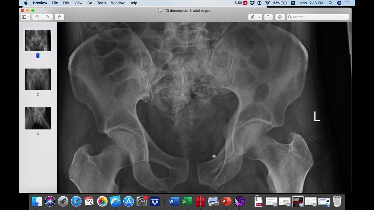 | MSK | Pelvic bone fractures |
