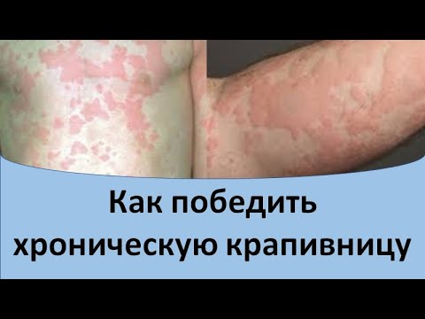 Как победить хроническую крапивницу.