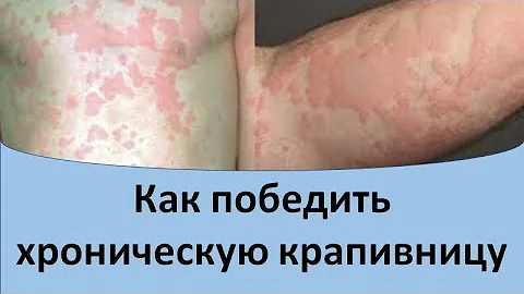 Как победить хроническую крапивницу.