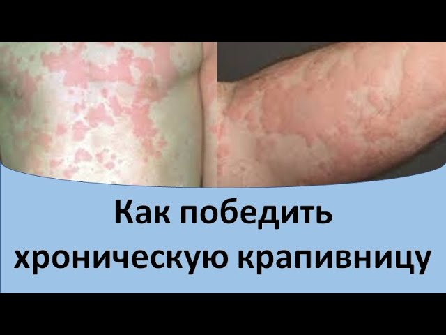 Как победить хроническую крапивницу. - YouTube