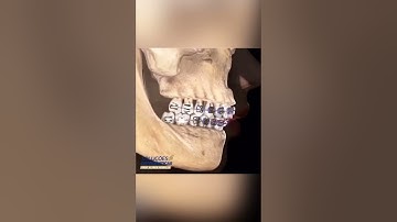 CLASS II ELASTICS - ORTHODONTIC TIPS #Shorts