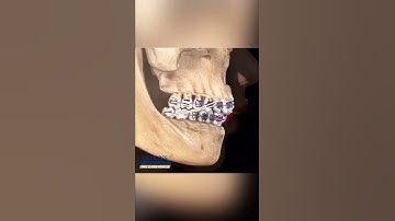 CLASS II ELASTICS - ORTHODONTIC TIPS #Shorts