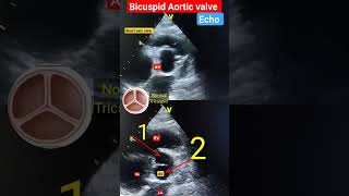 Echo Of Bicuspid Aortic Valve L Short Axis View L