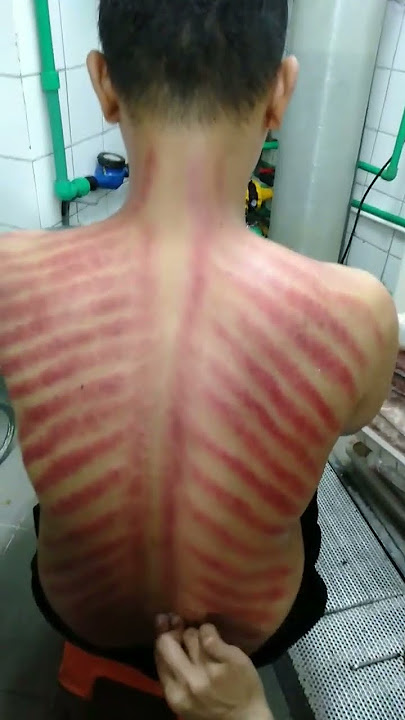 Trik cara kerokan yang benar di jamin anggin hilang #ragil #shortsvideo #viral