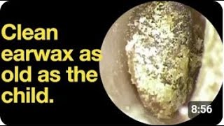 Extreme Ear Wax Removal - Clean earwax as old as the child | ear wax removal | audiology associates