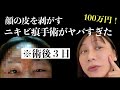 顔の皮を剥がして治療するニキビ痕美容手術が100万円したのに効果なくて逆にスタンディングオベーション