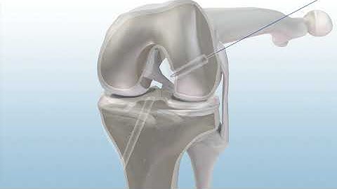 MEDHOLD curved anatomic btb acl reconstruction using genesys matryx