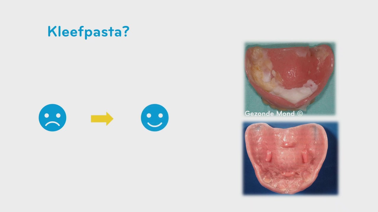 Noodlottig shit Doorzichtig Kleefpasta en de gebitsprothese - YouTube