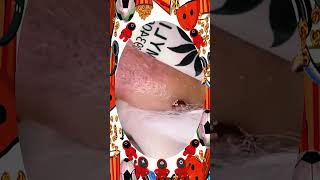 Blackheads Removal #469 | Acne Treatment and Very Satisfying Satisfying Pimple pop #blackheads