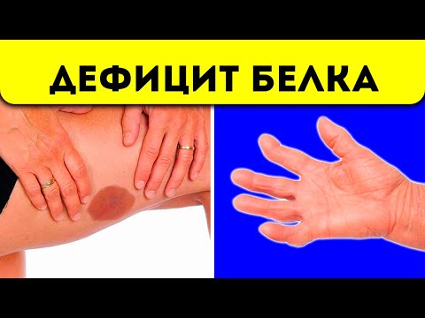 ДЕФИЦИТ БЕЛКА в организме! ЧТО ТВОРИТ недостаток БЕЛКА с организмом