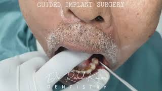 SINGLE VISIT PAINLESS DIGITALLY GUIDED DENTAL IMPLANT