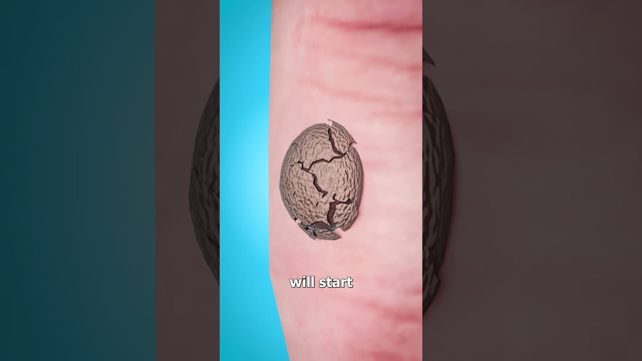 How Warts Are Frozen Off 