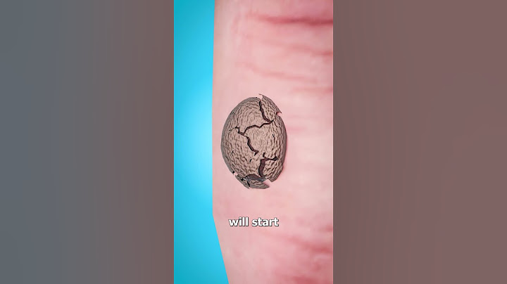 How Warts Are Frozen Off 🥶
