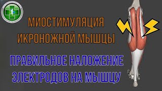 Миостимуляция икроножной мышцы голени. Правильное наложение электродов миостимулятора.