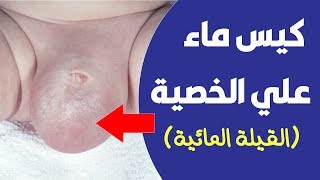 اسباب انتفاخ الخصية عند الاطفال 👈  كيس ماء علي الخصية (القيلة المائية)