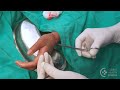 How to Suture a Wound - Emergency Care Series