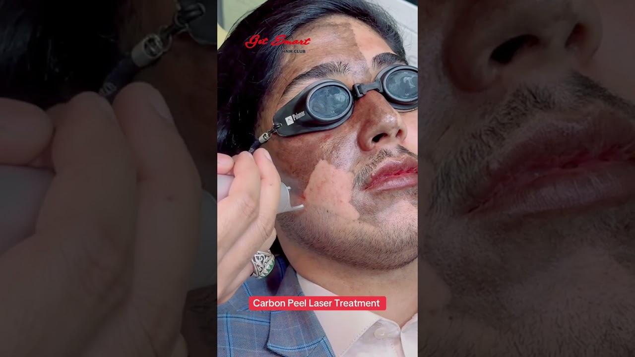 Carbon Peel Laser Treatment