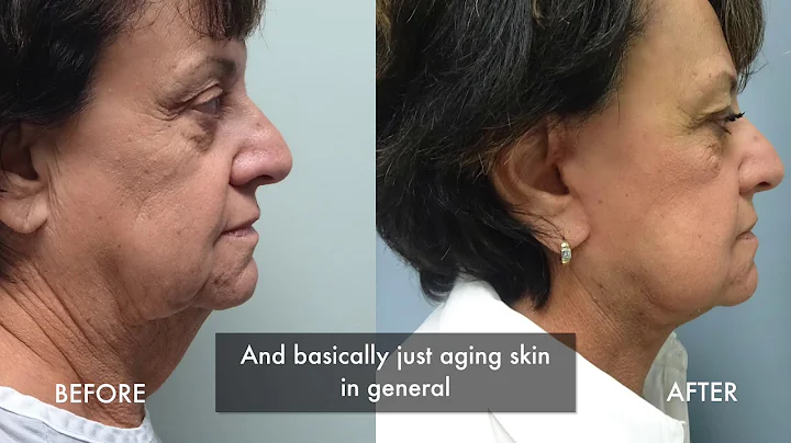 Understanding Facelift Surgery - Tampa Cosmetic Su...