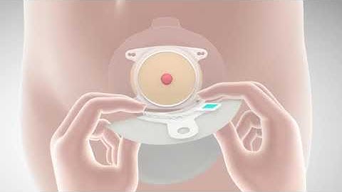 How to apply SenSura Mio 2-piece Click (nurse)