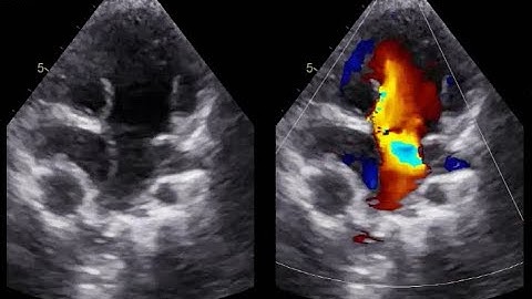 Fontan Procedure Echocardiography