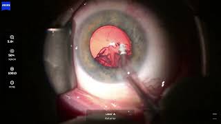 05 Phaco Lucia ASX8 g47ue 261019 OVD: ProVisc