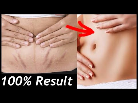 How to Remove Stretch Marks FAST | Reduce Acne Scars in  days | JSuper kaur