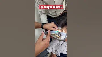 Ear Fungus Removal 