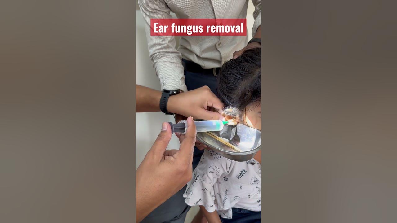 Ear fungus removal Ear fungus removal