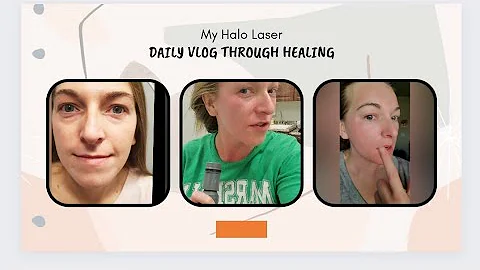 La mia esperienza con il trattamento laser Halo: guarigione quotidiana e risultati prima e dopo!