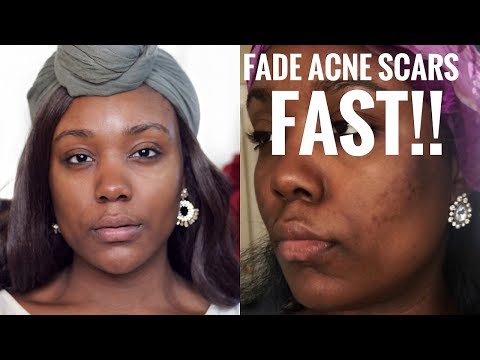 How to Get Rid of Acne & ACNE SCARS FAST AT HOME!!  REMOVE DARK SPOTS & HYPERPIGMENTATION FAST!!