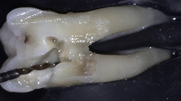Caries leveraged access and single stroke TCA technique with Hyflex EDM max curve