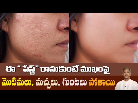 Remove Pimples and Acne Scars by Homemade Face Pack | Dark Spots | Dr. Manthena's Beauty Tips