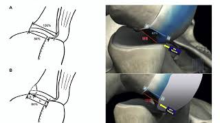 Shoulder Instability - ABOS Orthopedic Surgery Board Exam Review