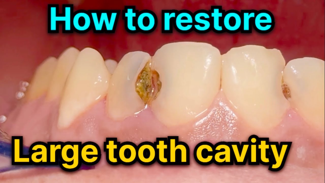 Restoring Rct Tooth Anterior Teeth Composite Restoration After RCT - YouTube