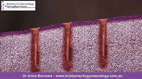 MonaLisa Touch - Dr. Anna Burrows